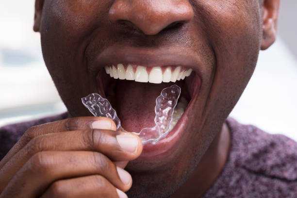 Clear Aligners Treatment